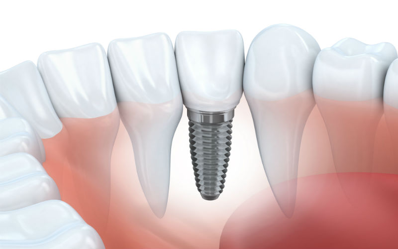 Dental Implants Charleston, SC: Replacing A Missing Tooth